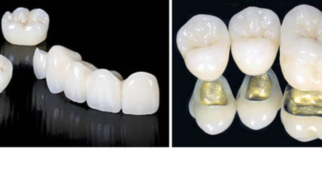 Front Tooth Crowns Photo 539