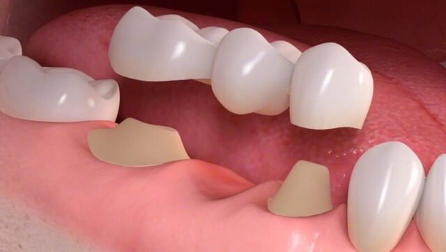 Front Tooth Crowns Photo 538