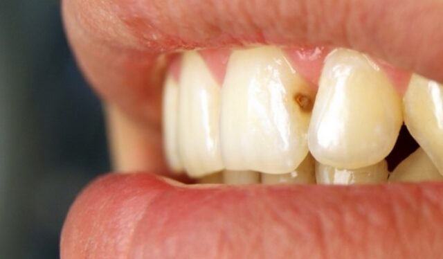 Interproximal Cavities Photo 308