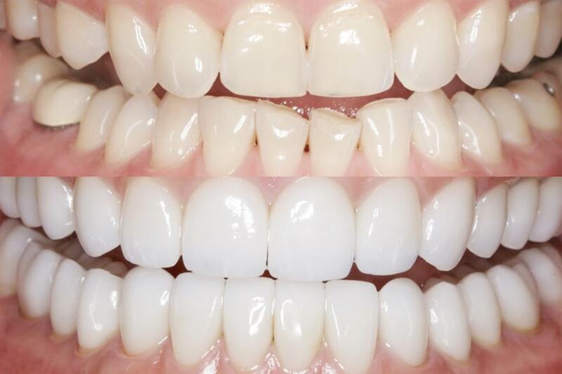 Dental Composite Restoration Photo 542