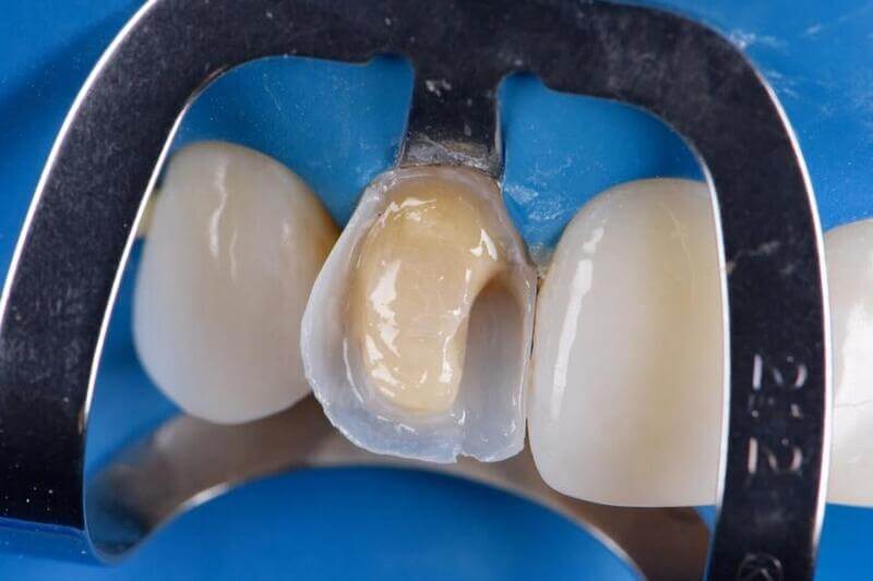 Dental Composite Restoration Photo 540