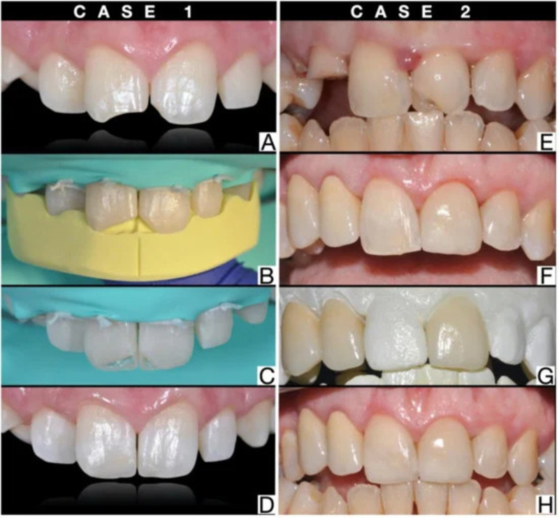 Dental Composite Restoration Photo 541