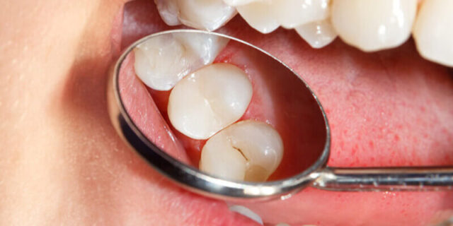 Interproximal Cavities Photo 310
