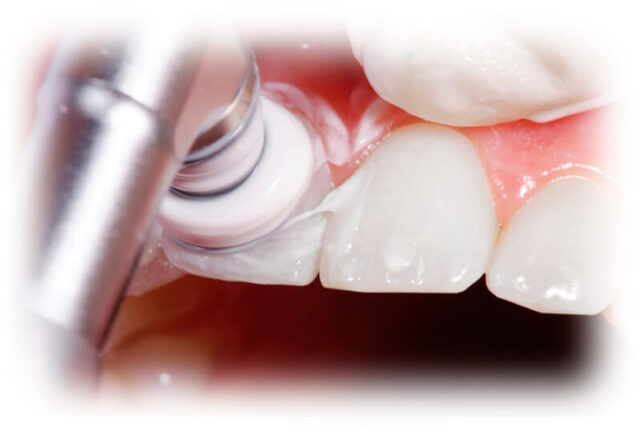 Photopolymer Restoration and Teeth Whitening