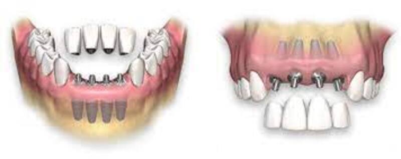 Anterior Teeth Implant Placement