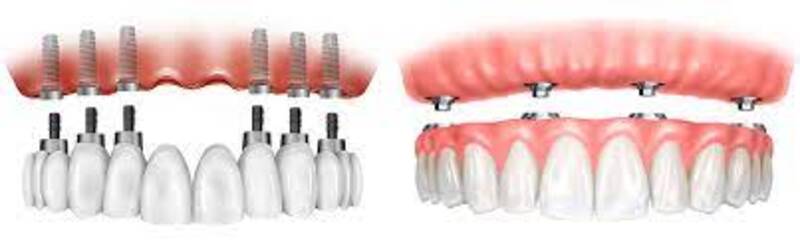 Implant Treatment of Edentulous Jaws