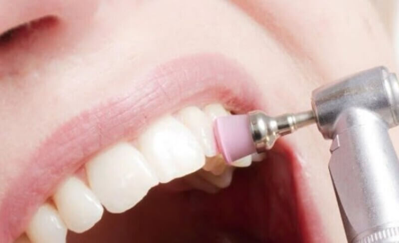 How to eliminate the imperfections of the enamel