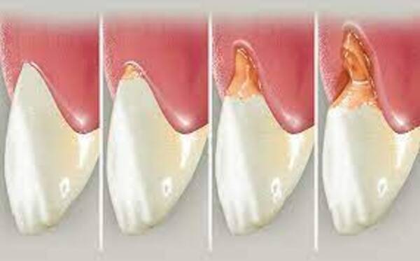 Classification and types of gums recession