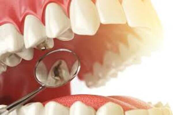 Tooth Decay Treatment