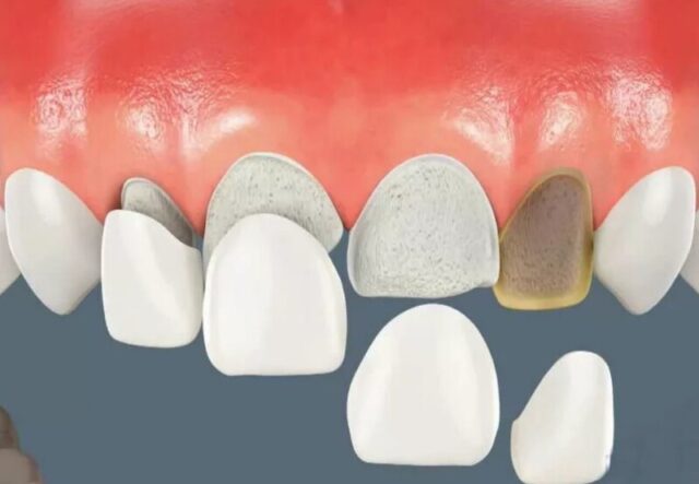 Indirect restoration: Crowns, Implants, Veneers, Veneer grafting