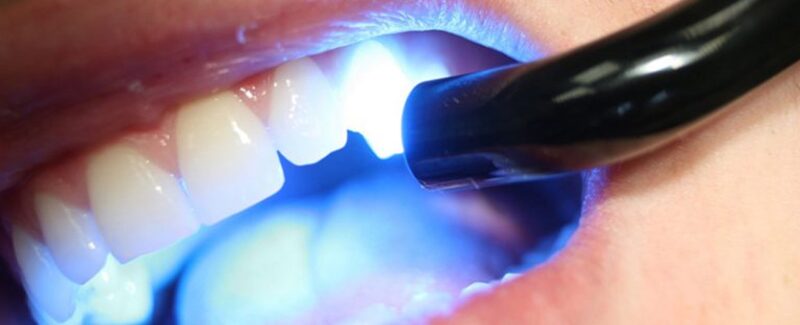 Пломба на передньому зубі потемніла: методики лікування