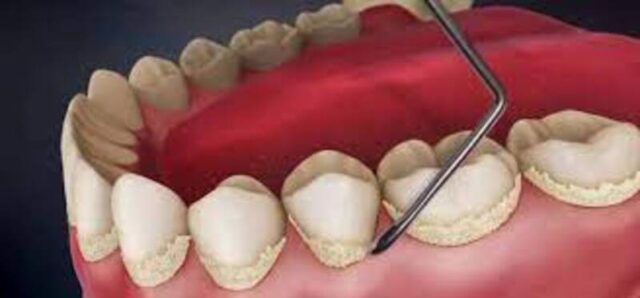 Why do gums recede?