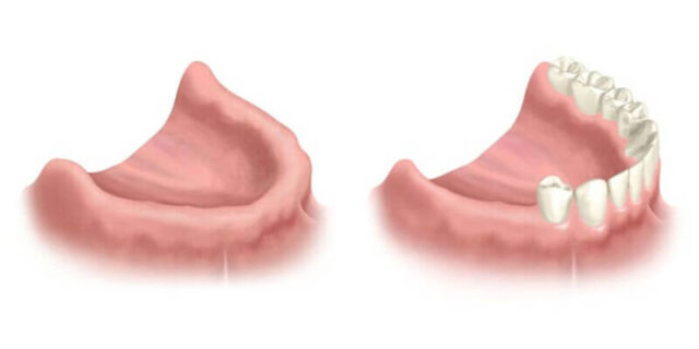 Dental implantation indications