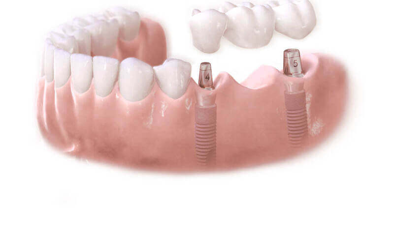 Установка зубных имплантов как ставят импланты зубов Фото 578