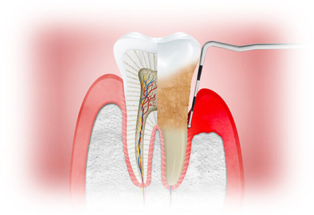 A piece of tooth broke off around the filling: complications