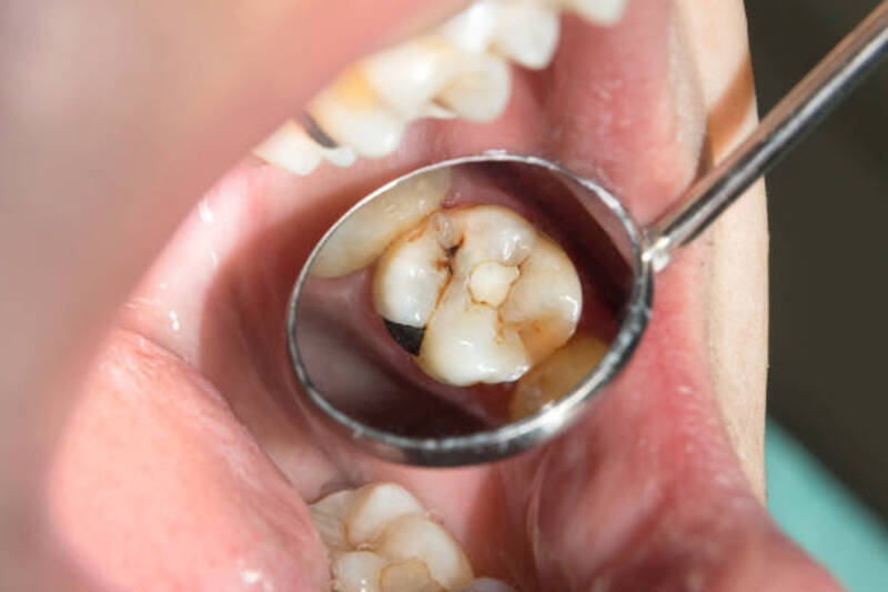 Симптоми гниття зубів