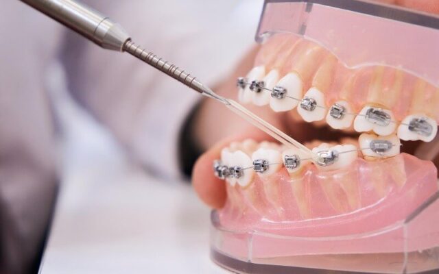 Dental Hygiene with Braces