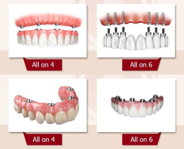 Types of Implants and Techniques