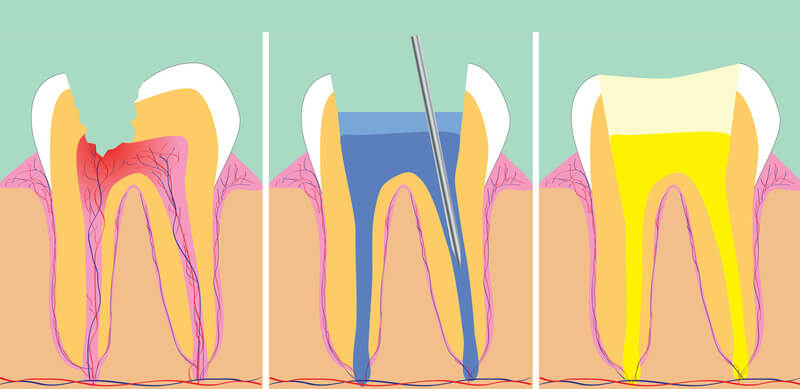 Що відбувається із зубами після видалення нерва