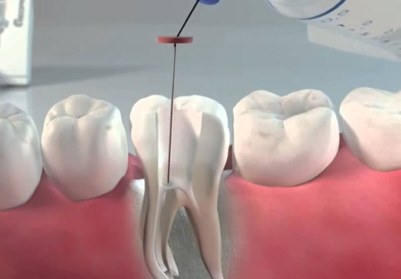 Зуб почорнів зсередини: як визначають захворювання