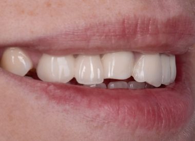 Objectively, the incisal edges of the zirconia bridges were chipped in the area of the two central incisors.