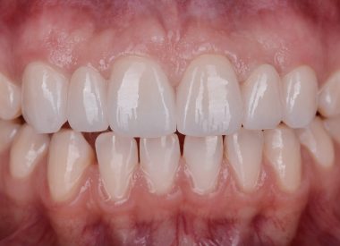We fixed the new zirconia crowns seven days later.