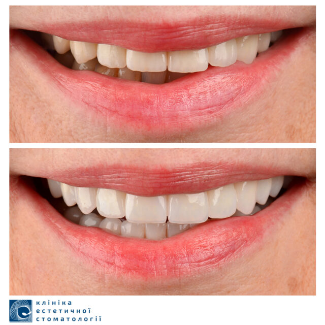 Grinding Down Teeth for Veneers photo