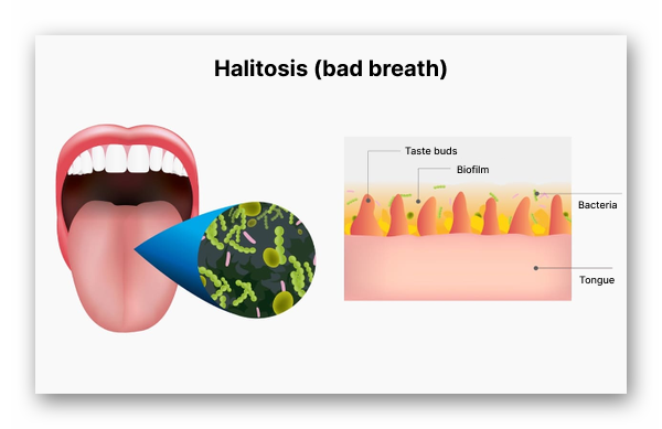 Causes of bad breath Photo 196