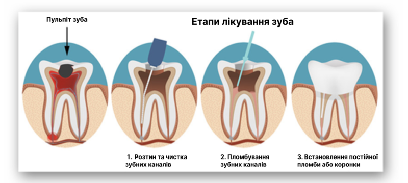 З чого розпочати лікування запущених зубів Фото 231