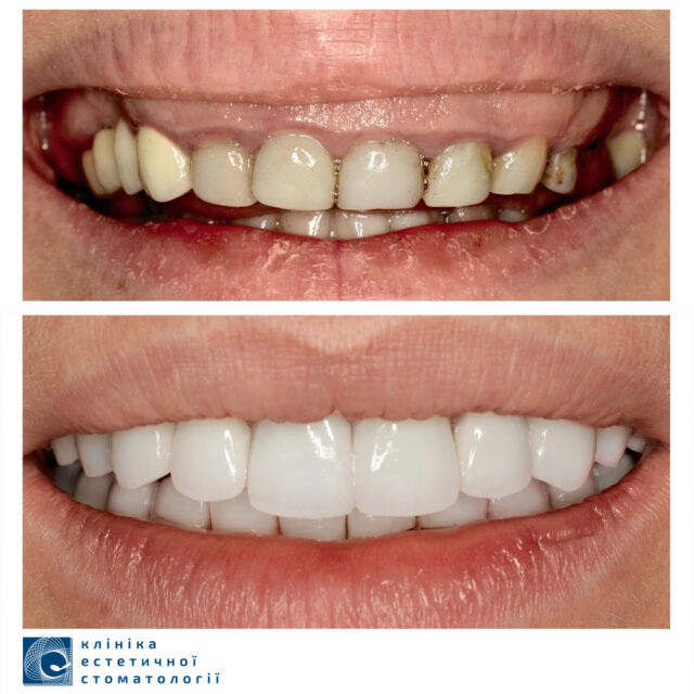 The Neglected Teeth Treatment: What to Start with photo