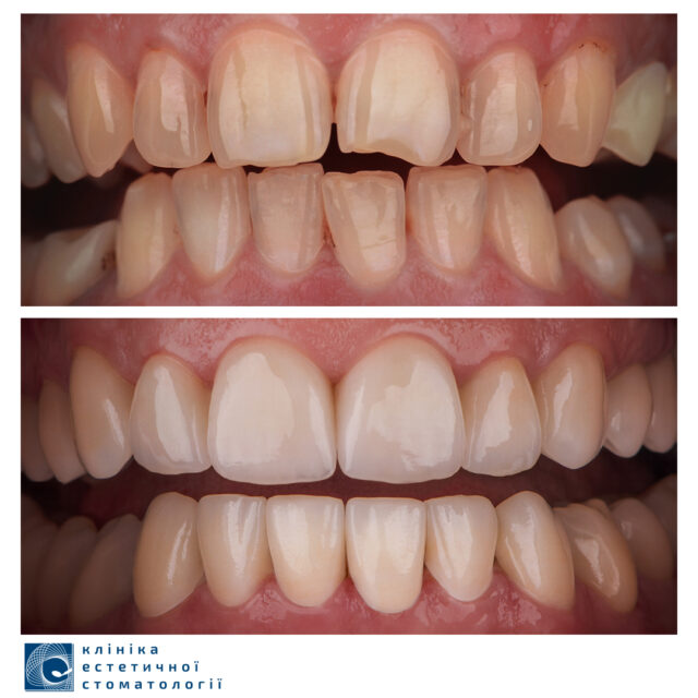 The Neglected Teeth Treatment: What to Start with photo