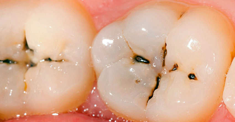 Black Lines on Tooth Fissures