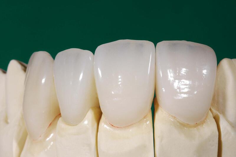 Ceramic Crowns for Front Teeth