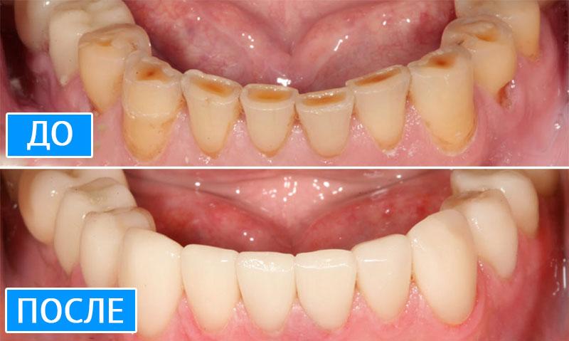 Коронки на передние зубы — до и после