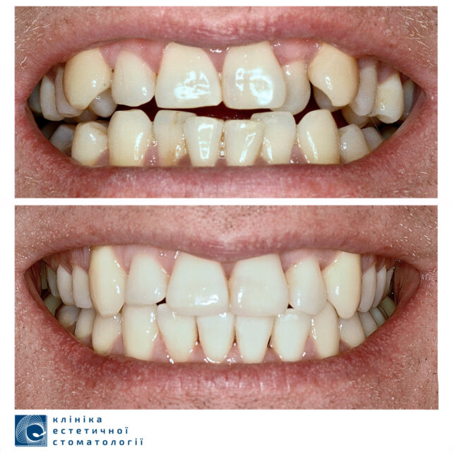 How to Straighten Teeth without Braces photo