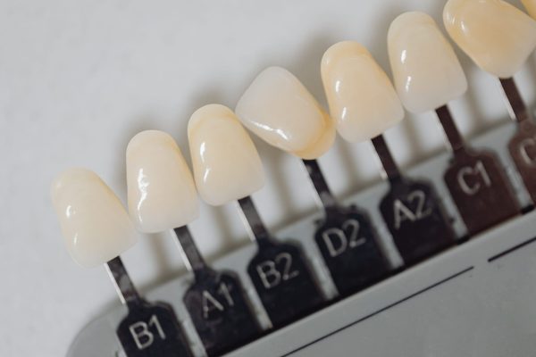 Crowns for Anterior Teeth