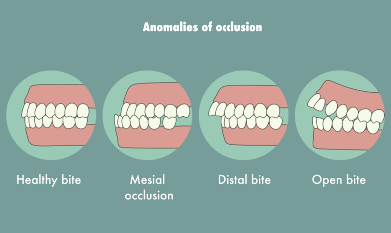 Anomalies of occlusion