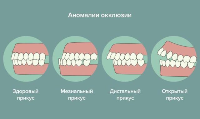 Аномалии окклюзии