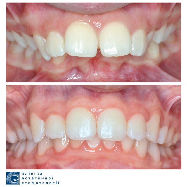 What Happens if Overbite Is Not Treated photo