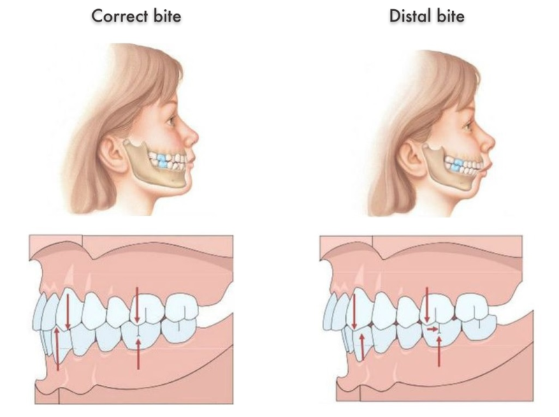 How braces change the face