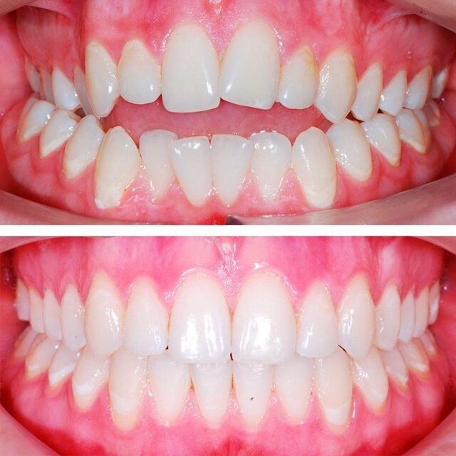 The jaw before and after wearing braces