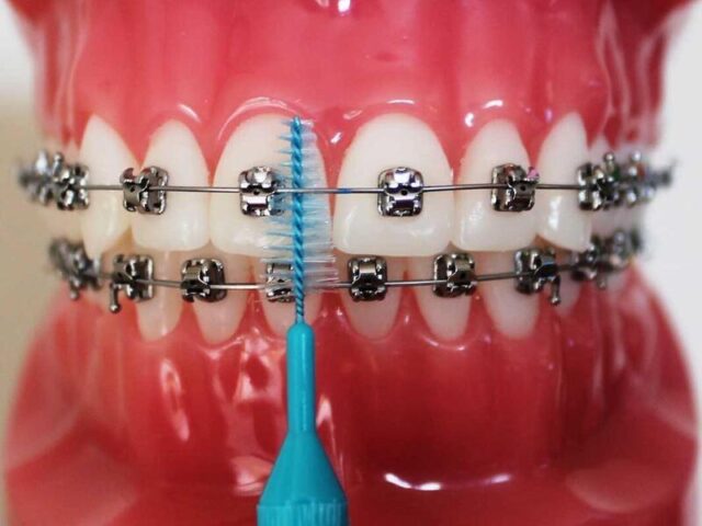 Bracket system on a dental model with a dental pick