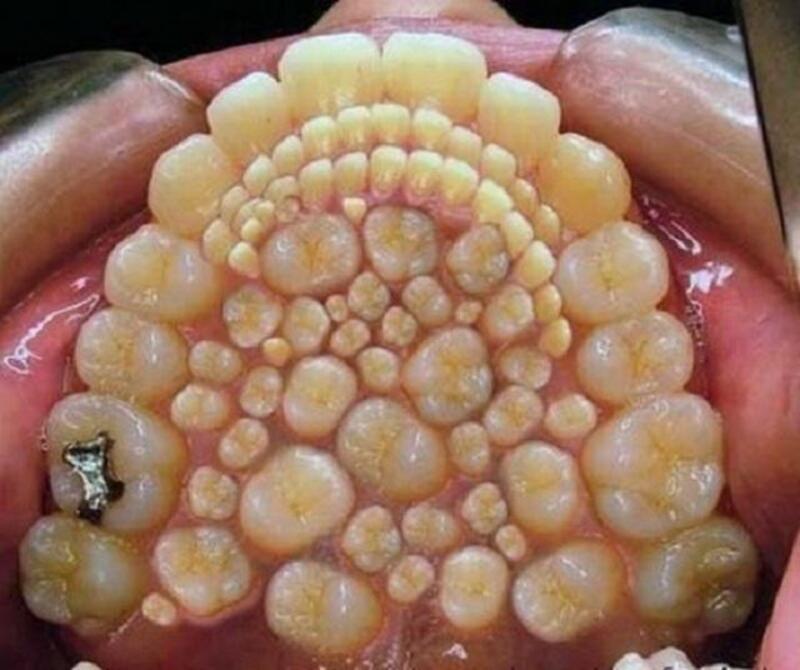 Supernumerary teeth