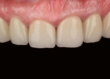 На нижней челюсти слева отсутствовало несколько зубов, присутствовали множественные пломбы и частичная стираемость.