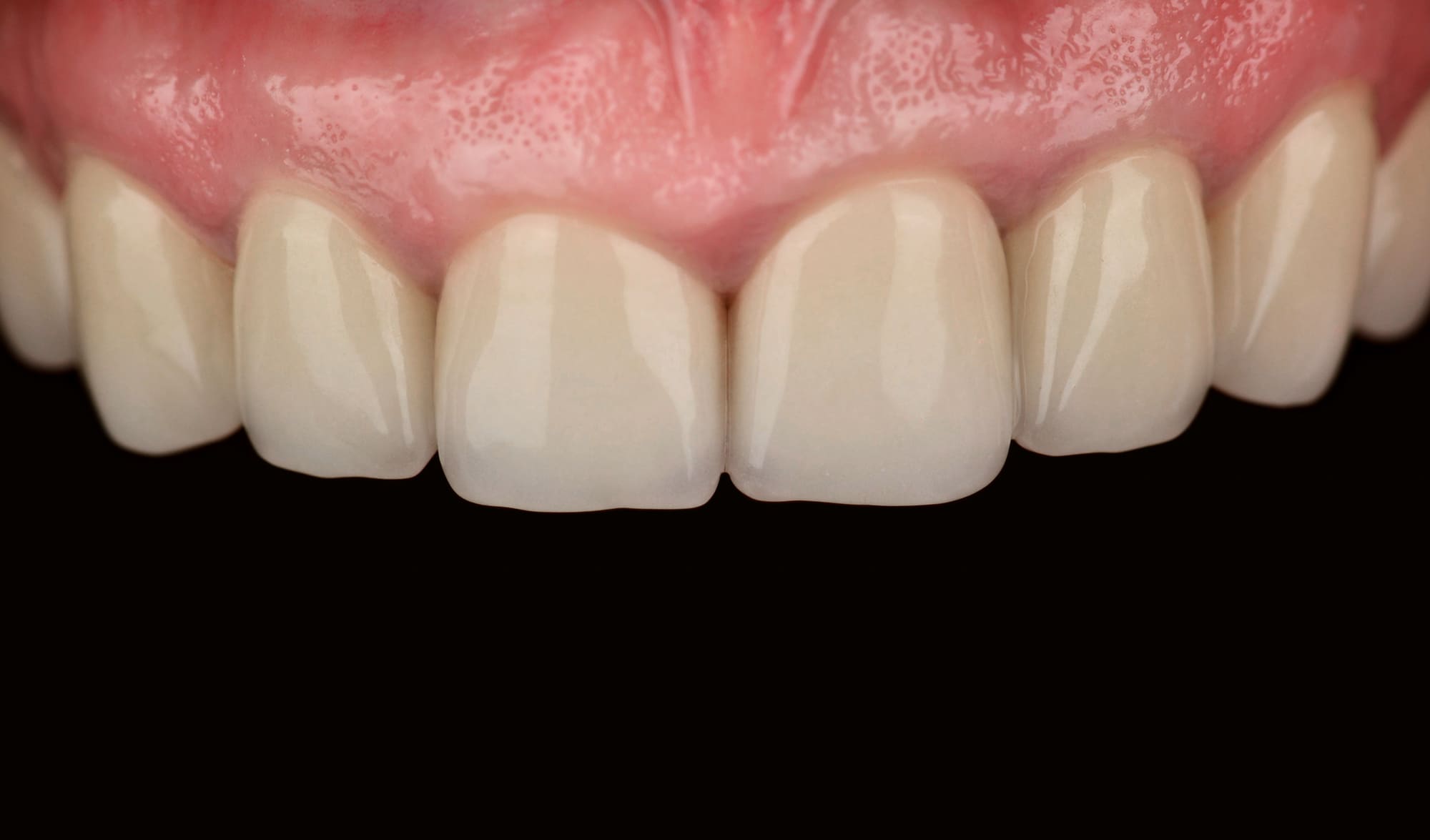 На нижней челюсти слева отсутствовало несколько зубов, присутствовали множественные пломбы и частичная стираемость.