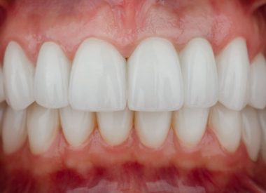 После обсуждения лечения с пациенткой, принято решение о санации нуждающихся зубов, имплантации зубов 35,37 и протезировании циркониевыми коронками.