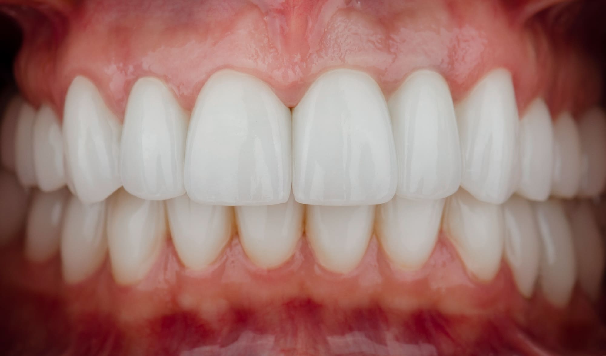 После обсуждения лечения с пациенткой,  принято решение о санации нуждающихся зубов, имплантации зубов 35,37 и протезировании циркониевыми коронками.
