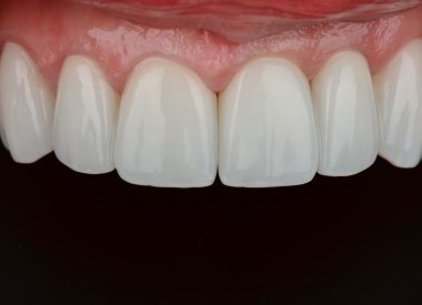 Prosthetics was carried out in several stages with fitting the prototype of the future teeth.