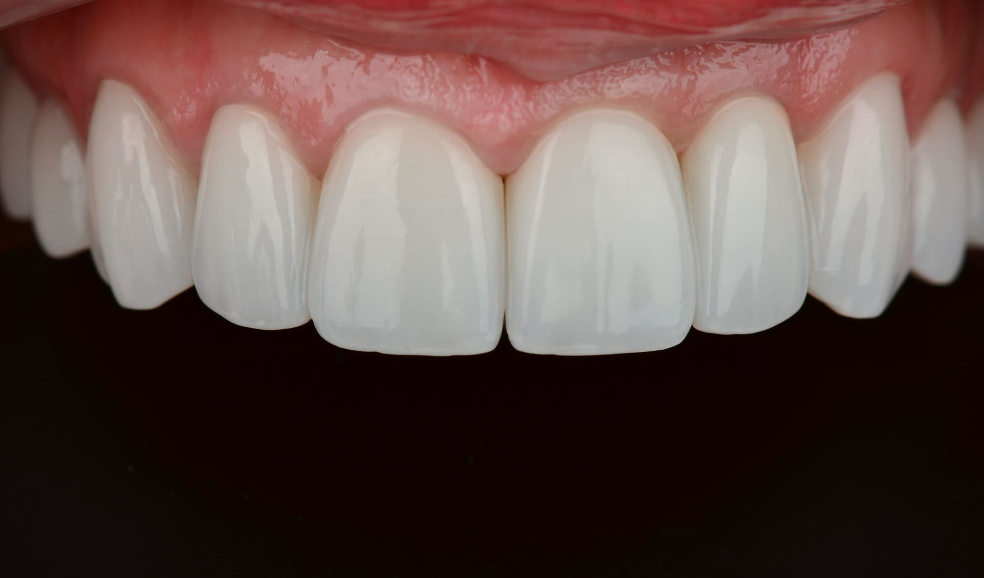Протезирование осуществлялось в несколько этапов с примеркой прототипа будущих зубов.