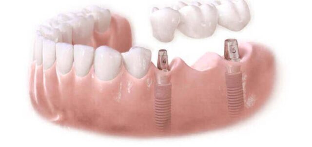 Implantation of implant-supported bridge on titanium rods